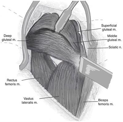 Approach to the canine coxofemoral joint using an osteotomy of the deep gluteal muscle insertion for total hip replacements